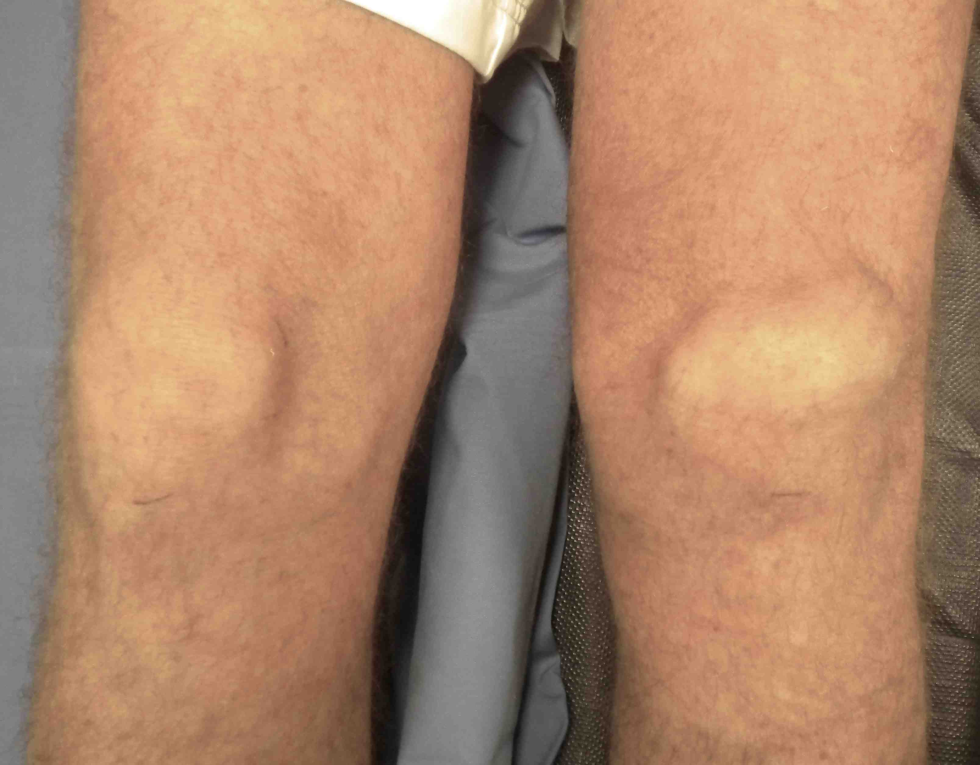 Quadriceps Tendon Rupture